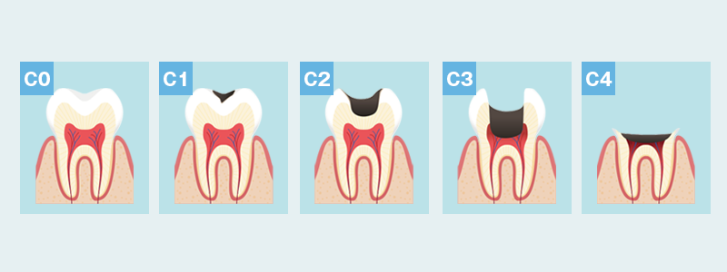 虫歯の進行と治療方法
