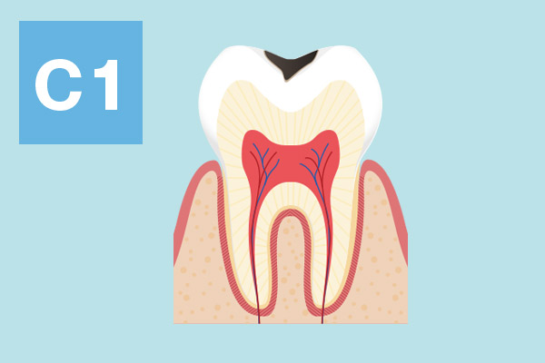 C1：歯の表面の虫歯