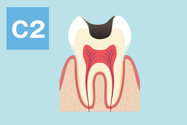 C2：神経に近い虫歯