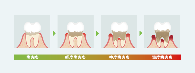 歯周病と治療方法