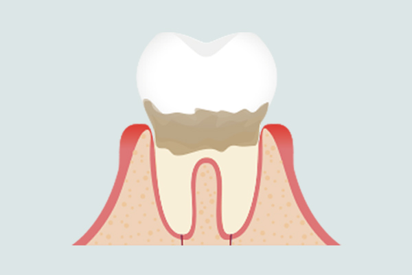 軽度歯周炎