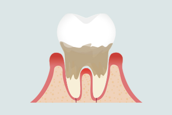 中度歯周炎