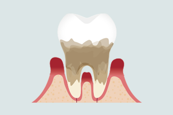 重度歯周炎
