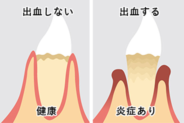 歯の出血を見る